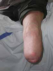 Transtibial Stump Transtibial Stump
